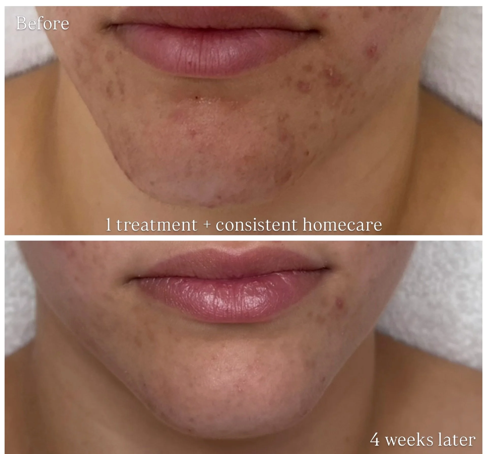 One treatment + consistent homecare🤍

This is what it looks like when the clinic and the home routine actually work together. No miracle, no quick fix. Just the right treatment, the right products and a client who stuck to the plan (so proud!🥹).

T