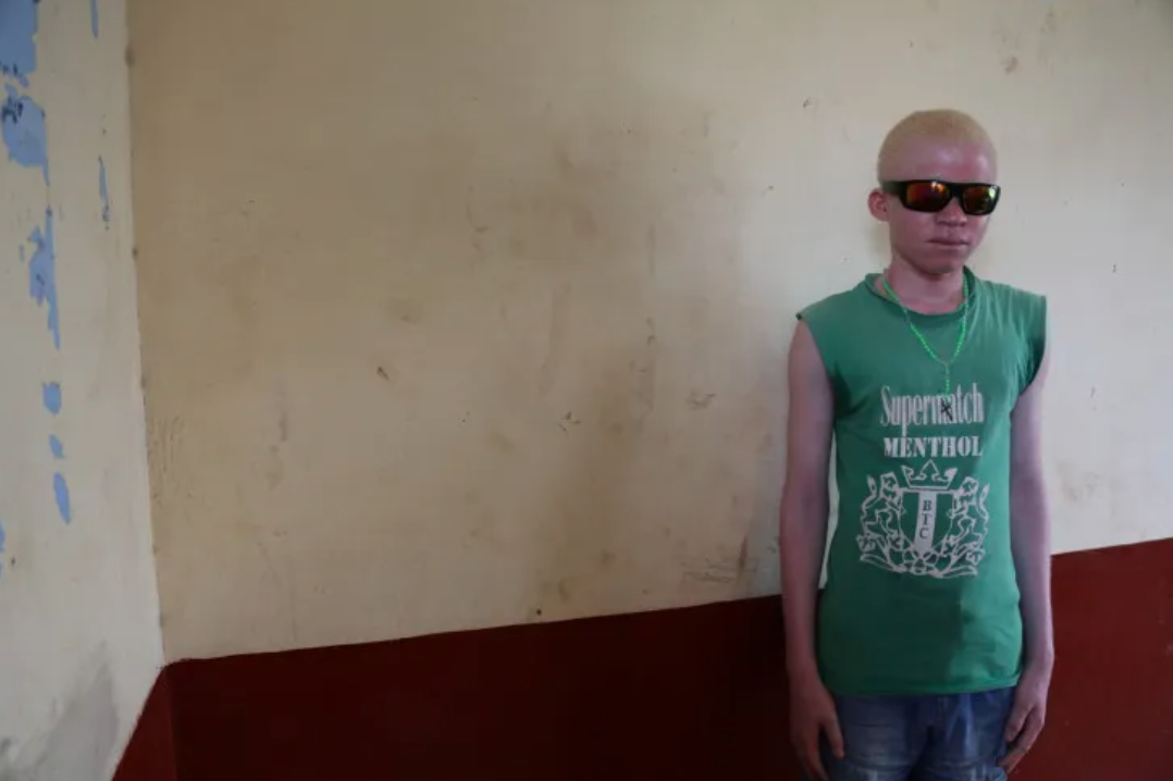 On the run from his own family: Young Burundian albino's escape to safety
