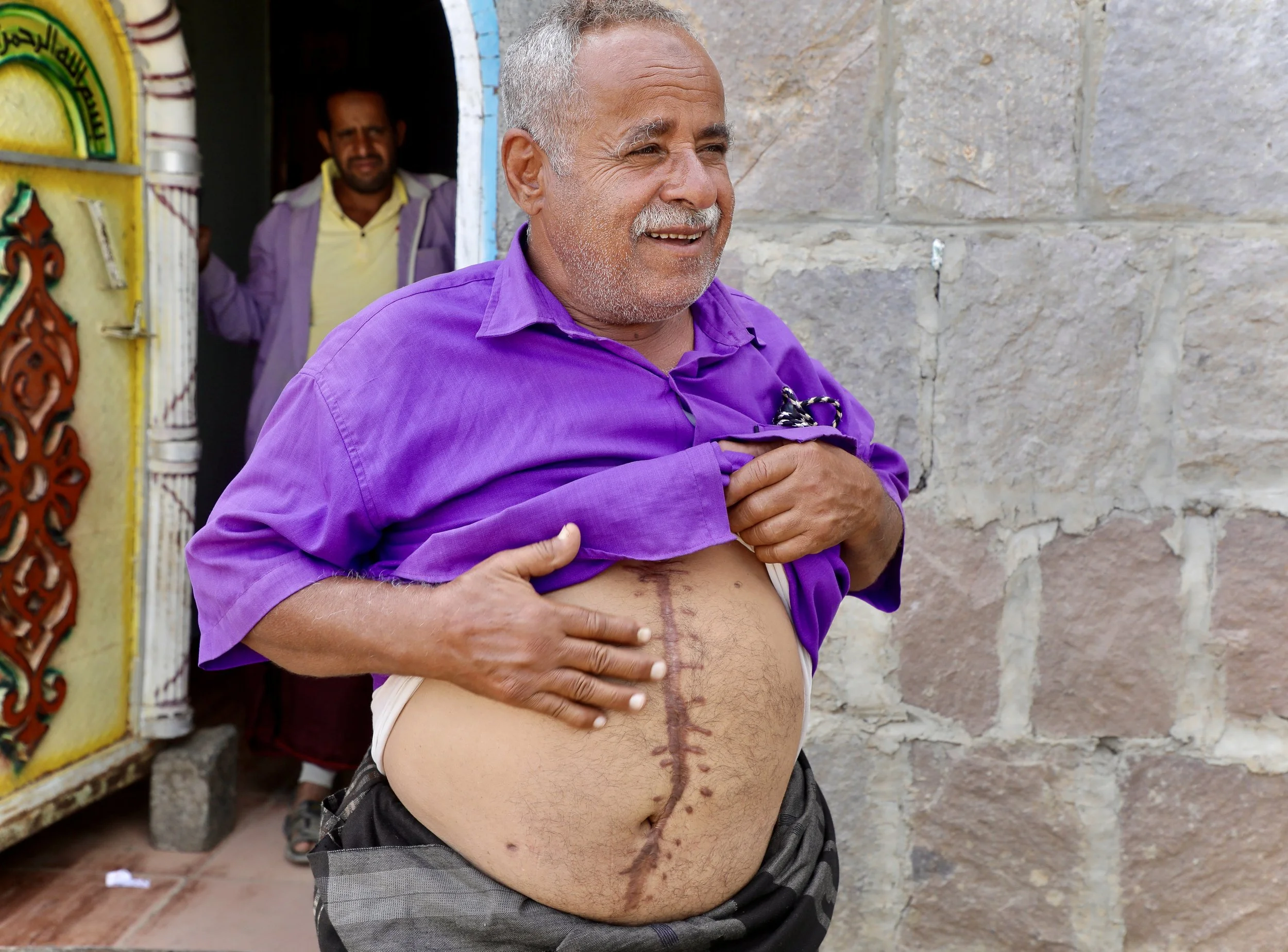 Mosaid Mohammed Ali Naji shows the injuries sustained when an IED exploded in his courtyard, Shakhab, Al Dhale. The vertical scar running down his abdomen is the result of surgery following the detonation. Mosaid, grandfather to 30, was displaced thr