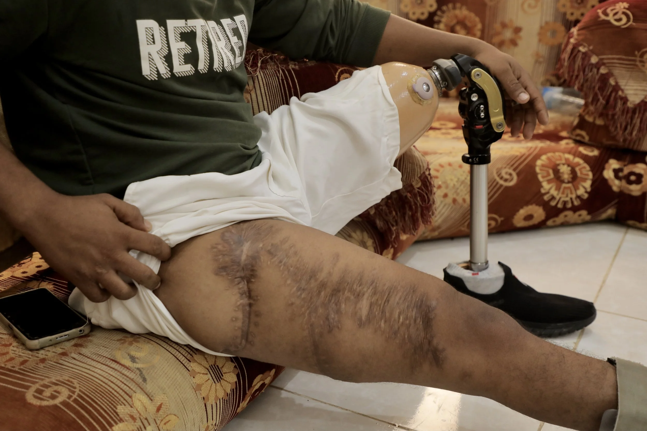 Scars from Mohammed’s landmine injury are visible beside his prosthetic leg. Several members of the family have worked in demining along Yemen’s western coast.