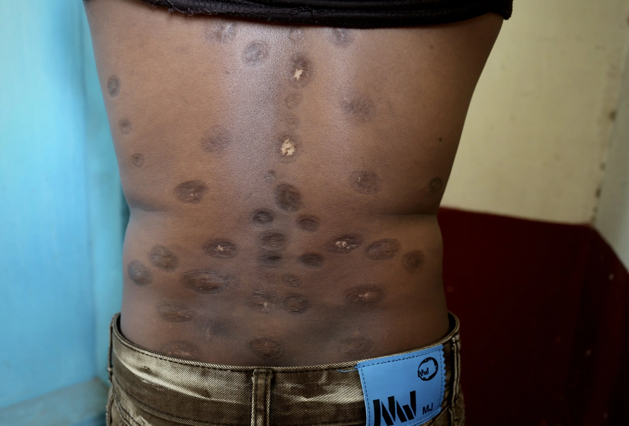 A Somali refugee displays scars that he said were the result of torture and ill-treatment. Kakuma, Kenya, June 2016.