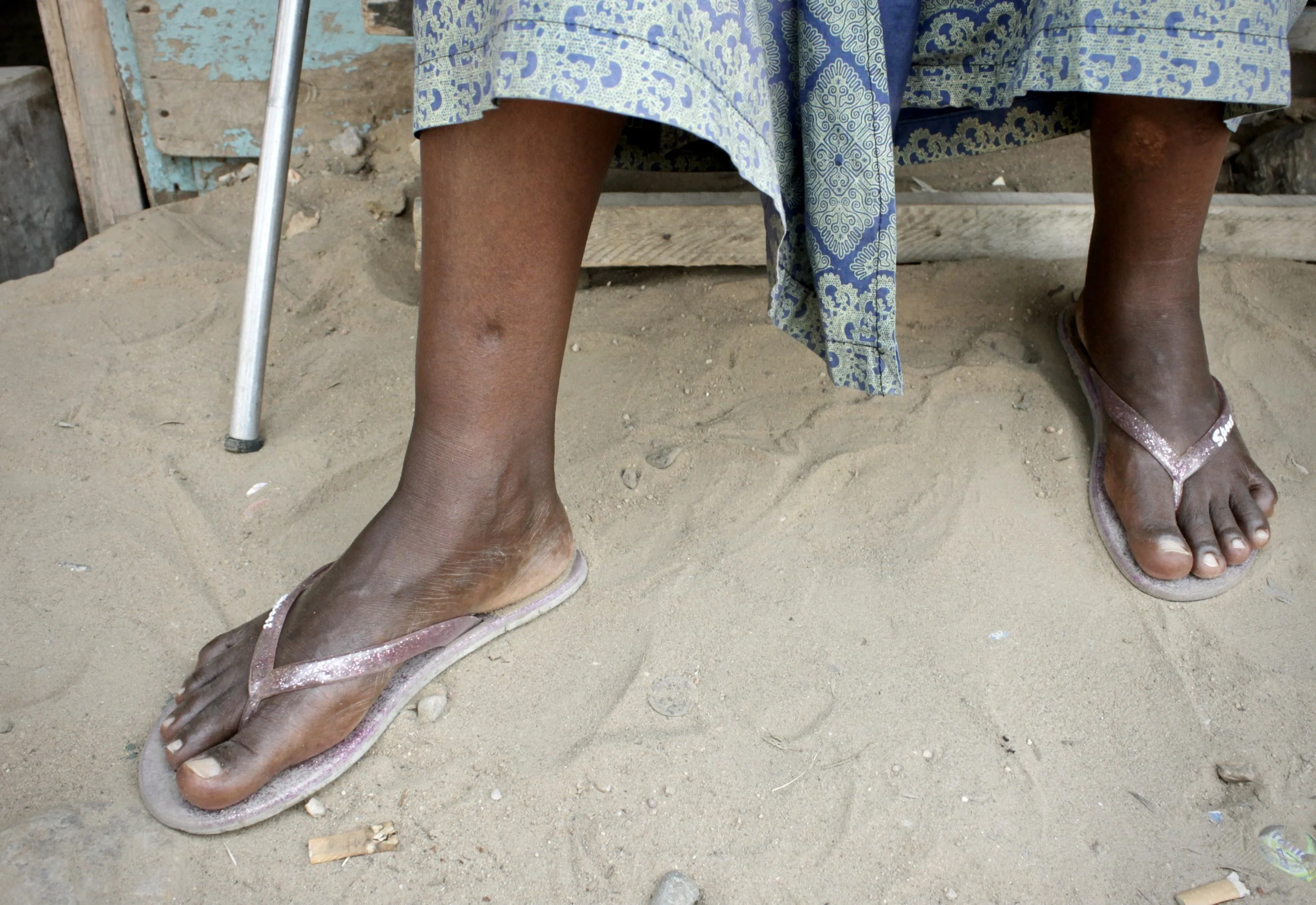 A scar remains visible on the leg of I.N., a 51-year-old mother of five who said police shot her during a search of her home in Mutakura. Officers allegedly accused her of hiding weapons beneath a sheet covering her two-week-old grandchild. The bulle