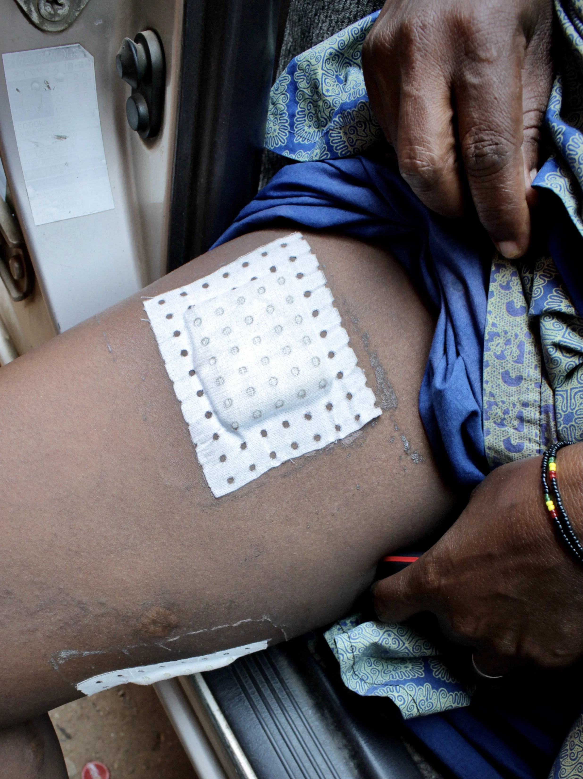 I.N. reveals dressings covering wounds on her thigh sustained during a police operation in Mutakura, Bujumbura. Before the shooting, she recalled telling officers: "I had no arms in the house, that my husband had died 11 years ago, and that if he fou