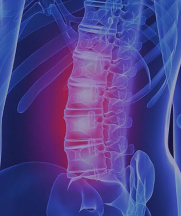 herniated disk.jpg