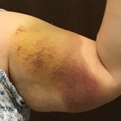 Bruised and swollen upper arm with discoloration from injury.