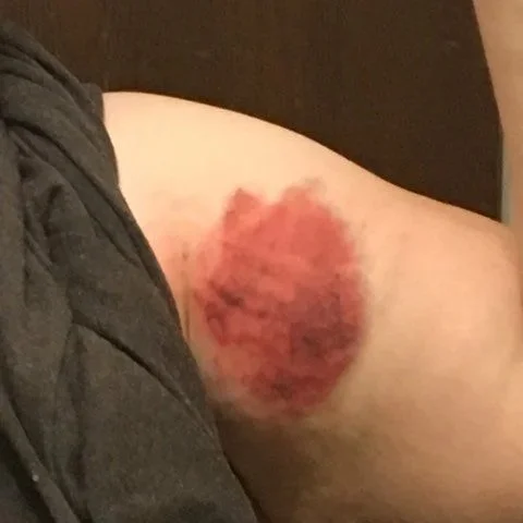 Initial tissue trauma