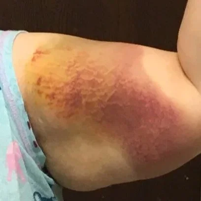 Bruised and discolored upper arm with yellow, purple, and red hues.