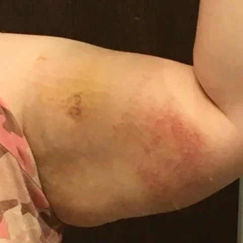 Close-up of a person's upper arm showing bruises and redness.