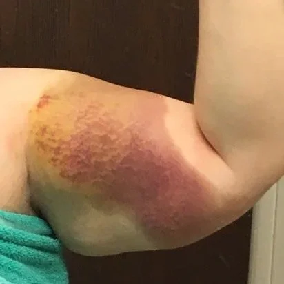 Close-up of a person's upper arm with significant bruising and discoloration.