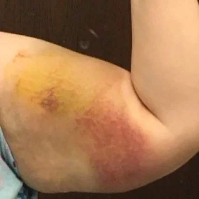 Close-up of a person's upper arm showing a bruise with yellow, purple, and red discoloration.