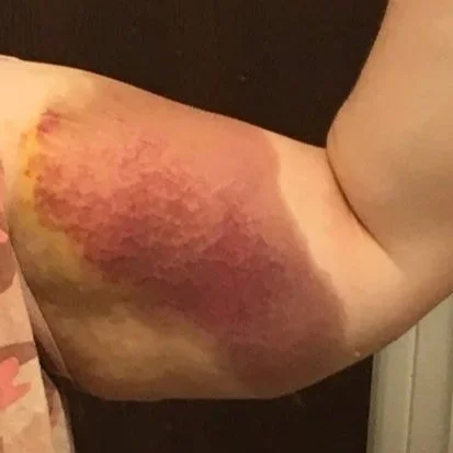 Bruised and discolored arm with visible redness and swelling.
