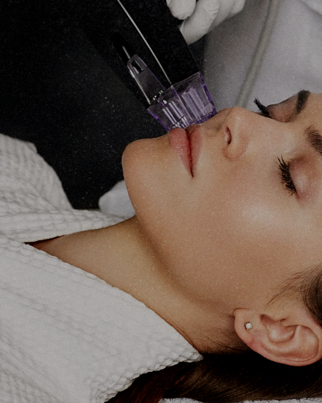 A woman with closed eyes receiving a facial treatment with a laser device on her cheek.