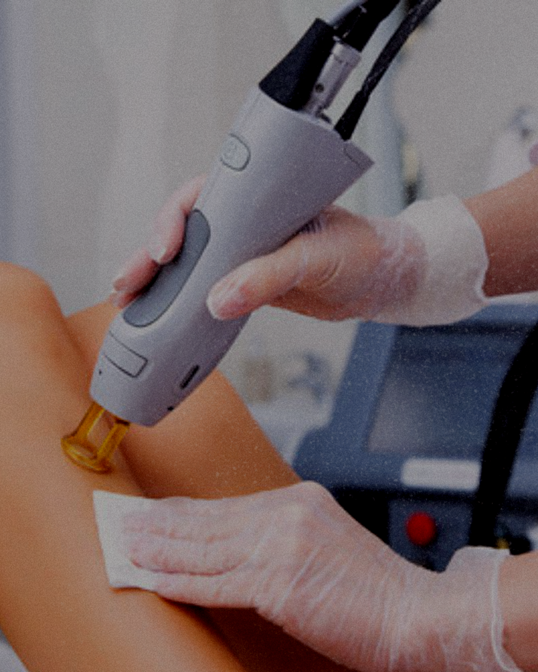 A medical professional using a laser device on a patient's arm, wearing gloves during a procedure.