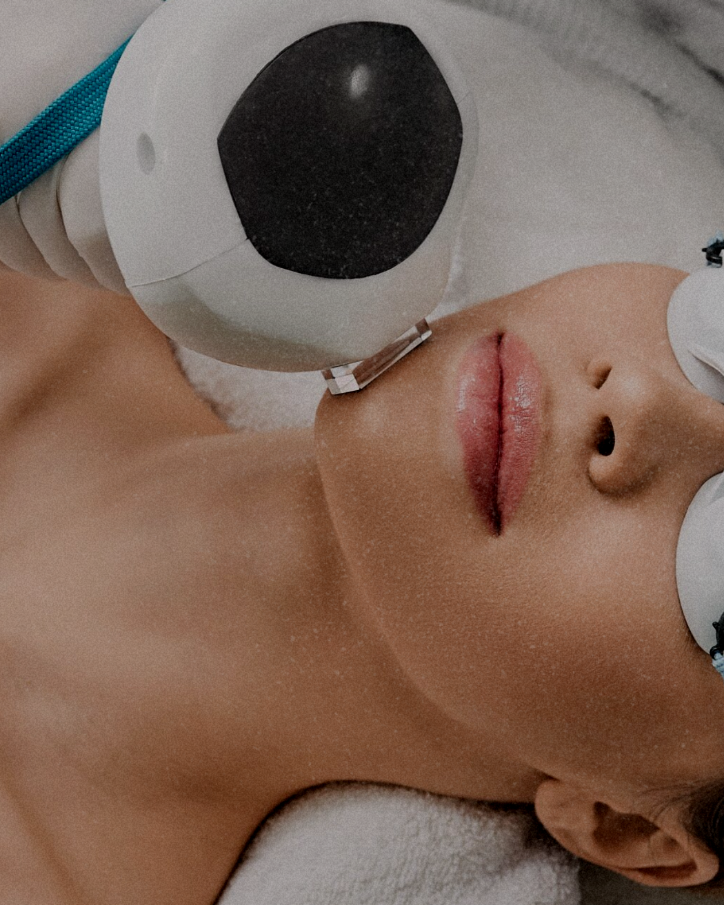 A person receiving a cosmetic laser treatment on their face, lying down with eyes closed, with a medical device held near the cheek.
