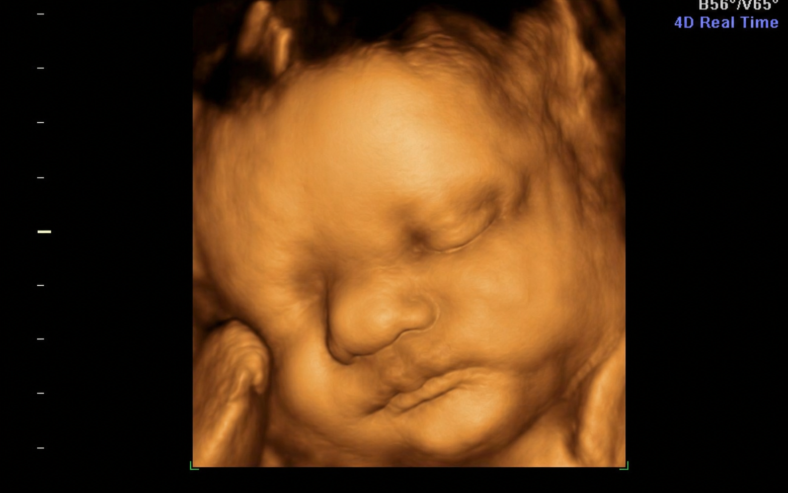 A 3D ultrasound image of a sleeping baby's face in warm brown tones, showing closed eyes, nose, and lips with a hand resting near the face.