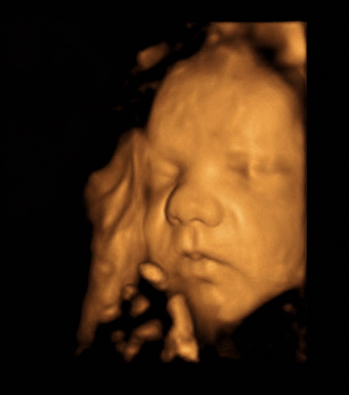 3D ultrasound image of a baby's face with closed eyes and hand near face.