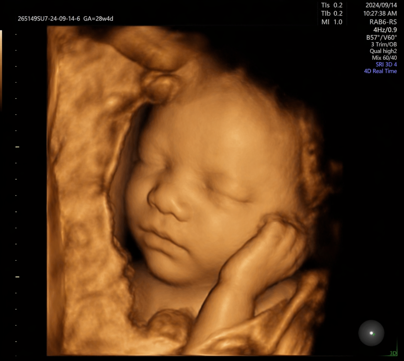 3D ultrasound image of a sleeping baby with closed eyes, holding one hand near the face, wrapped in a blanket.