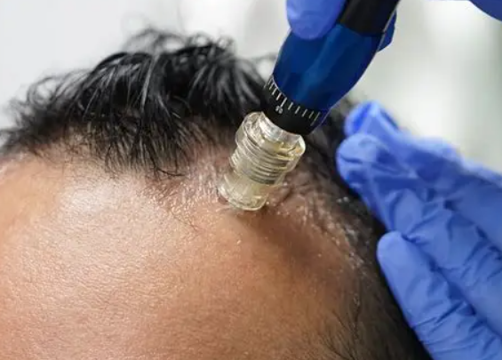 Paciente recebendo um procedimento de microneedling no couro cabeludo, com uma máquina especializada e uma pessoa usando luvas médicas.
