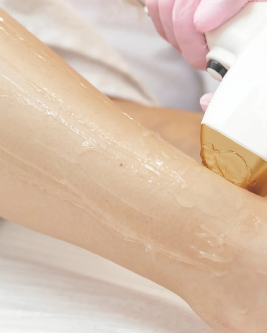 A person is undergoing a laser hair removal procedure on their legs, with a technician wearing gloves holding a handheld laser device against the skin.