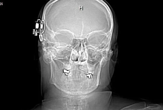 A cochlear story&hellip;&hellip;..The first time I heard it, I thought something was wrong with the bowl.

I poured cereal, added milk&hellip; and froze.

Tiny sounds.

Snap. Crackle. Pop.

I leaned closer, confused&mdash;then started laughing.

All 