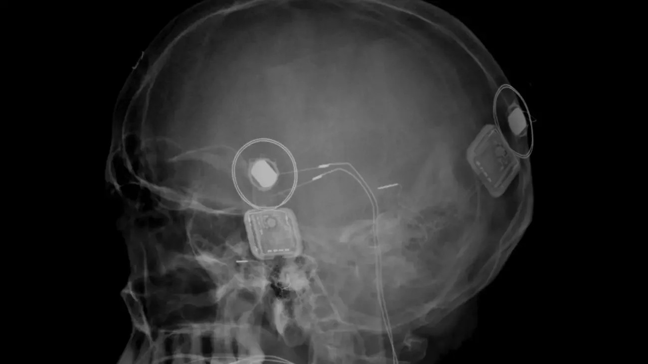 A cochlear implant story