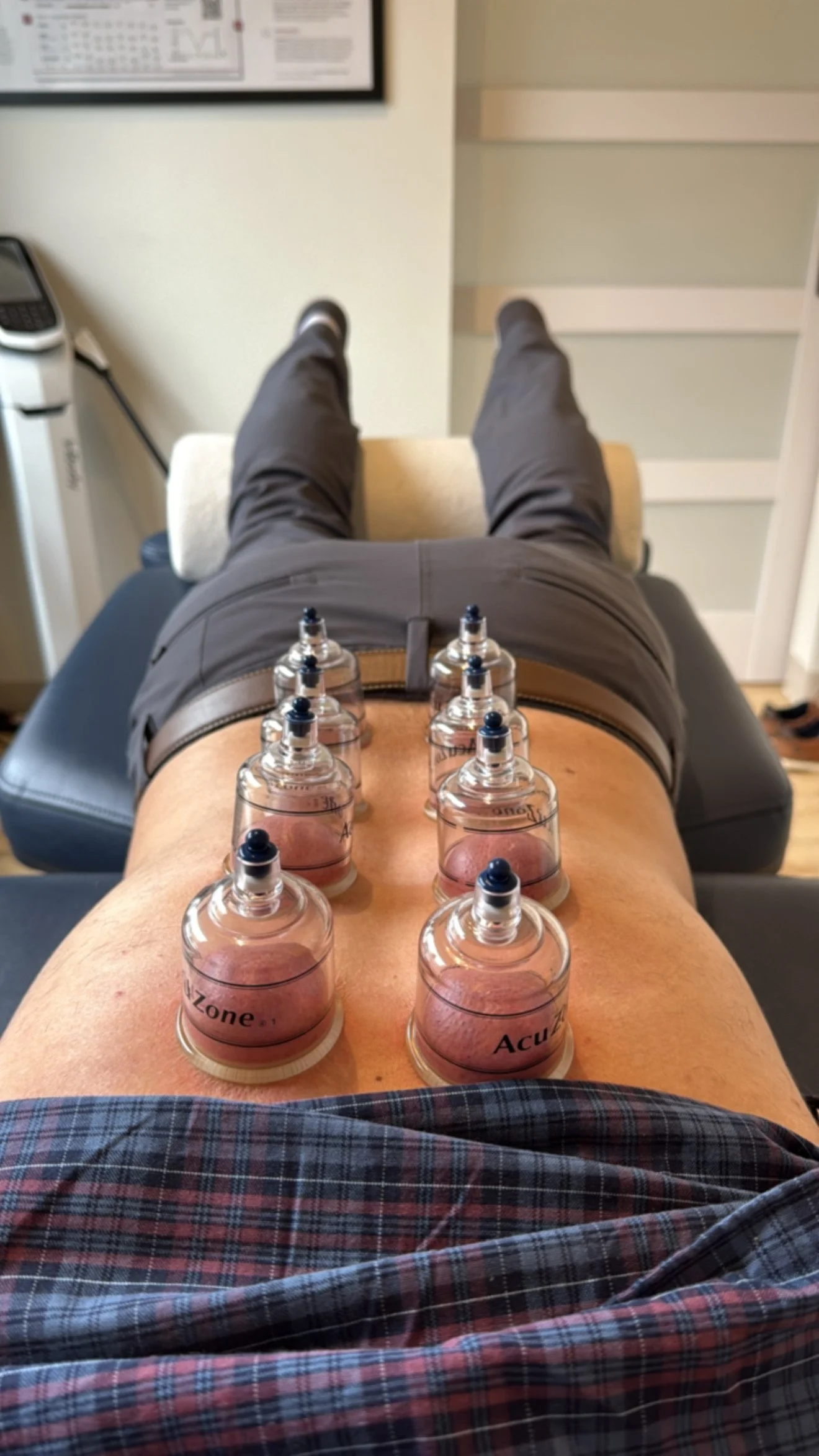 Person lying on a massage table with acupuncture needles on their stomach. A medical professional is performing acupuncture. Room has medical charts and equipment.