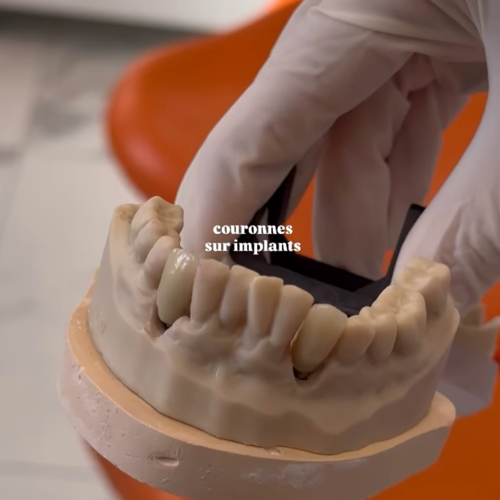 Model en silicone de mâchoire avec couronnes sur implants, étant manipulée avec des gants par un professionnel dans un environnement médical.