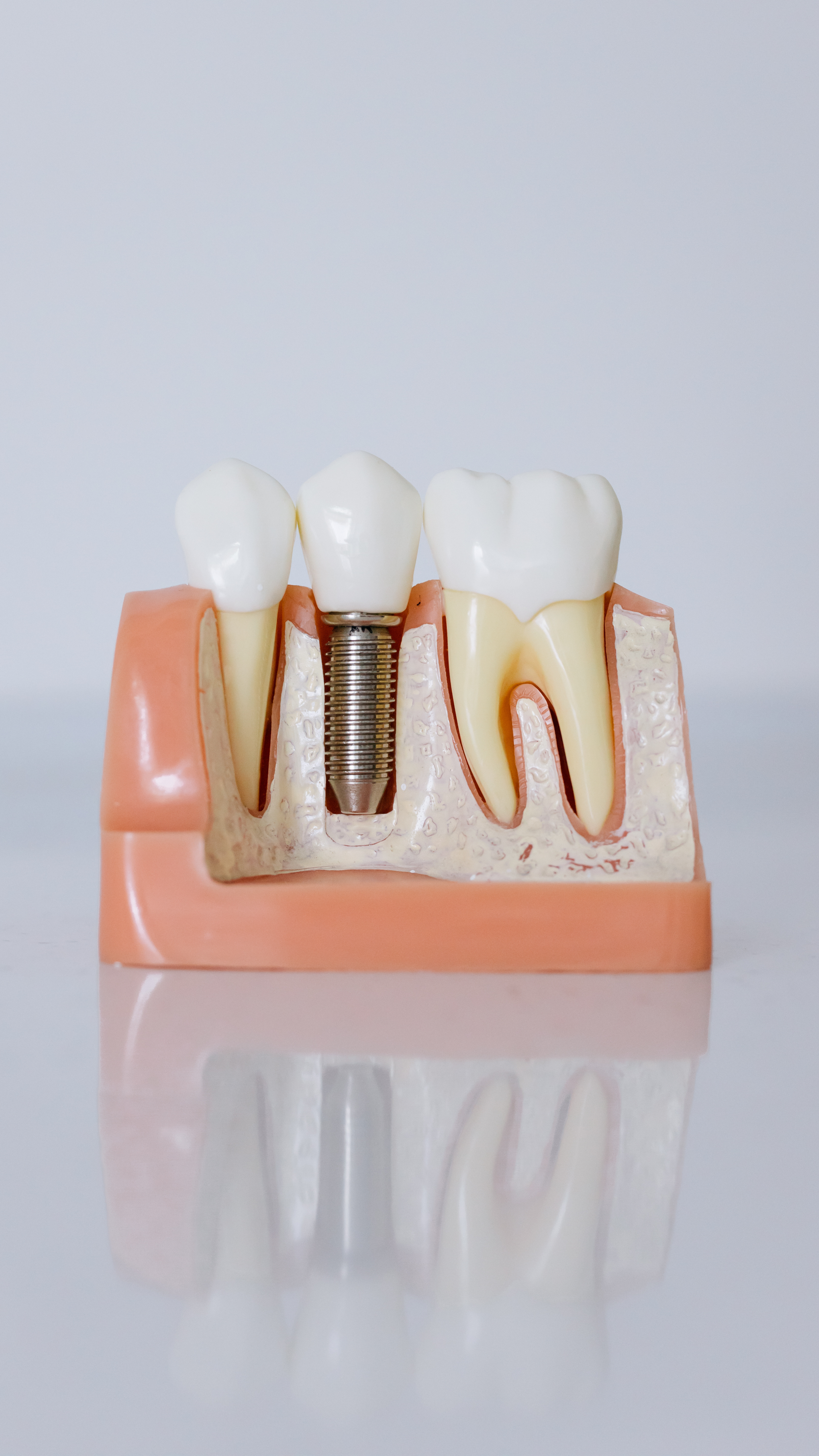 Modèle dentaire montrant une dent artificielle avec implant, entourée de dents naturelles et de gencives.