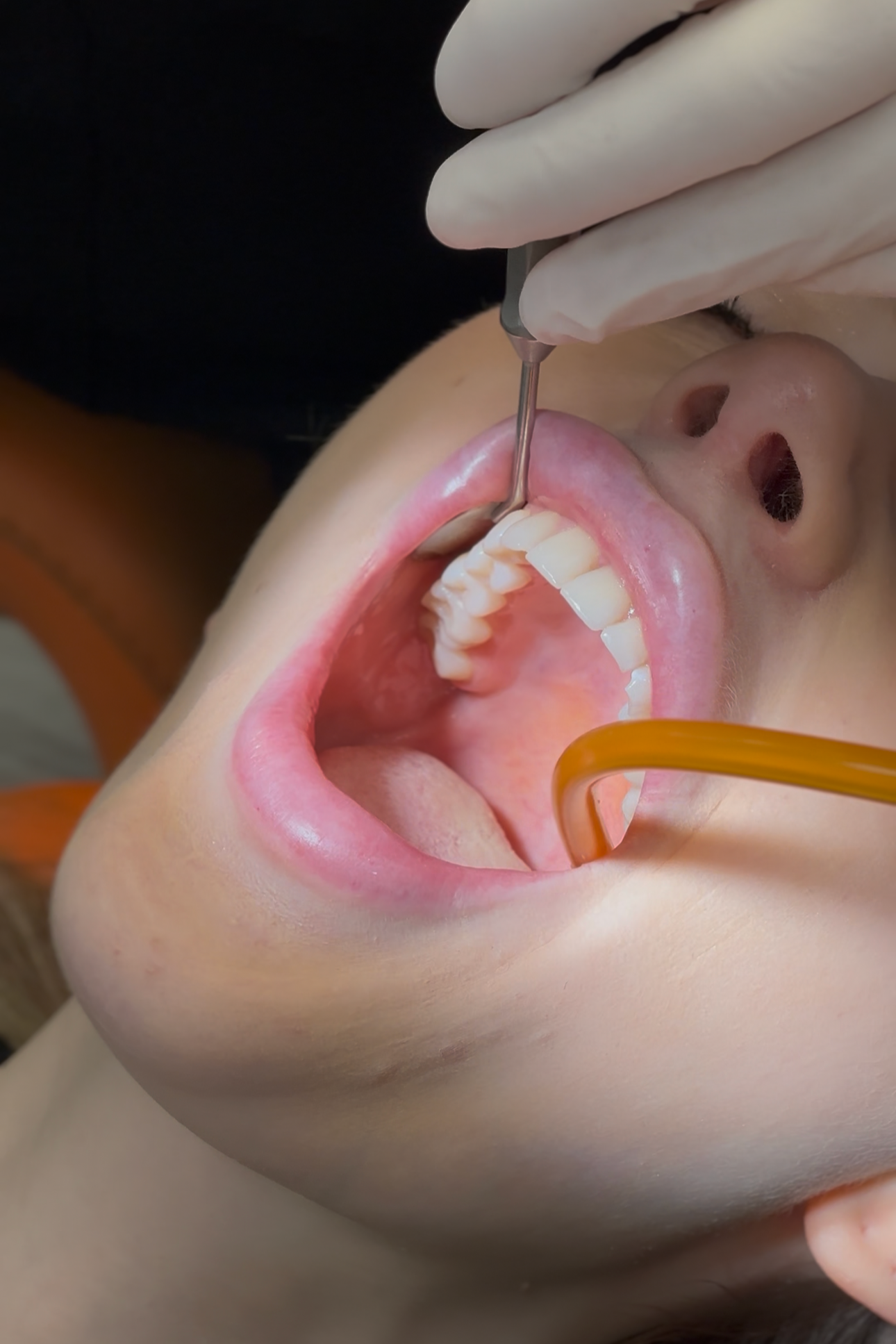 Une personne subit un examen dentaire avec un professionnel utilisant un instrument pour examiner l'intérieur de la bouche, notamment les dents et les gencives.