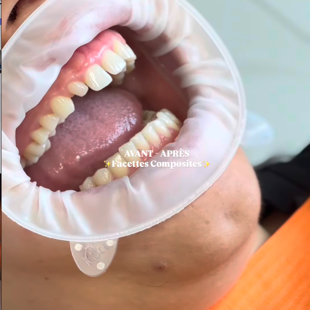 Vue rapprochée d'une bouche ouverte avec un masque facial en plastique transparent, montrant des dents avec des facettes composites.