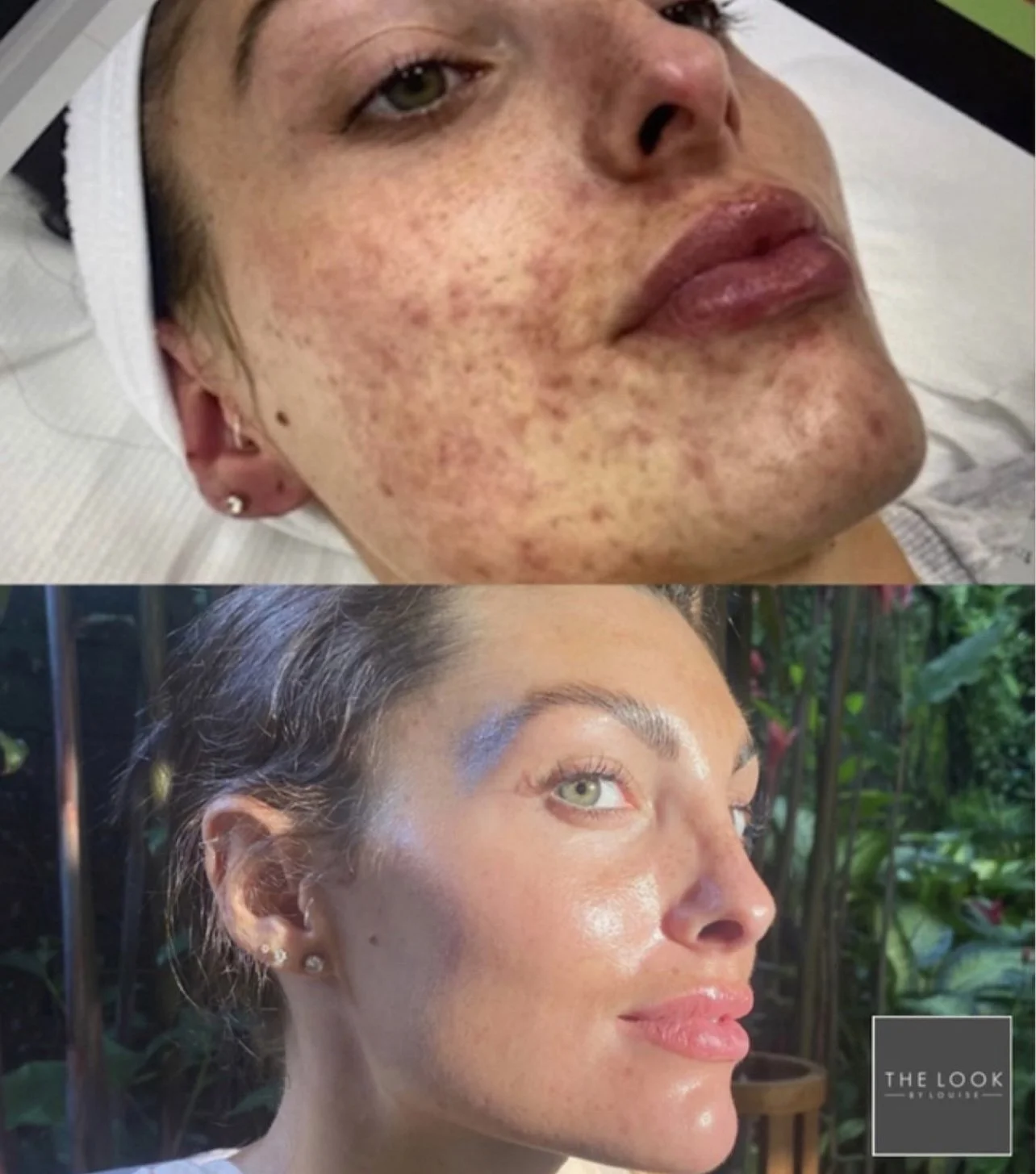 Before and after images of a woman, showing the transformation of her skin with improved texture and tone.