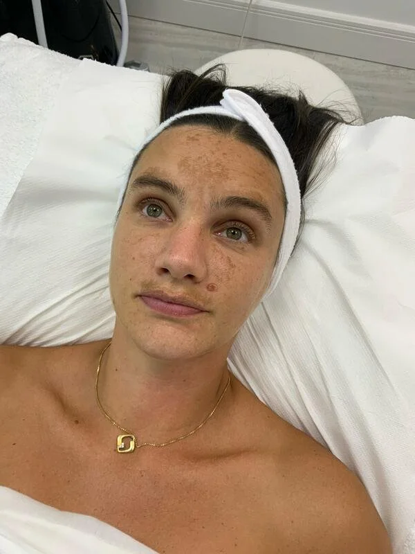 A woman with dark hair lying in a hospital bed, wearing a white headband and a gold necklace, with visible acne and blemishes on her face.
