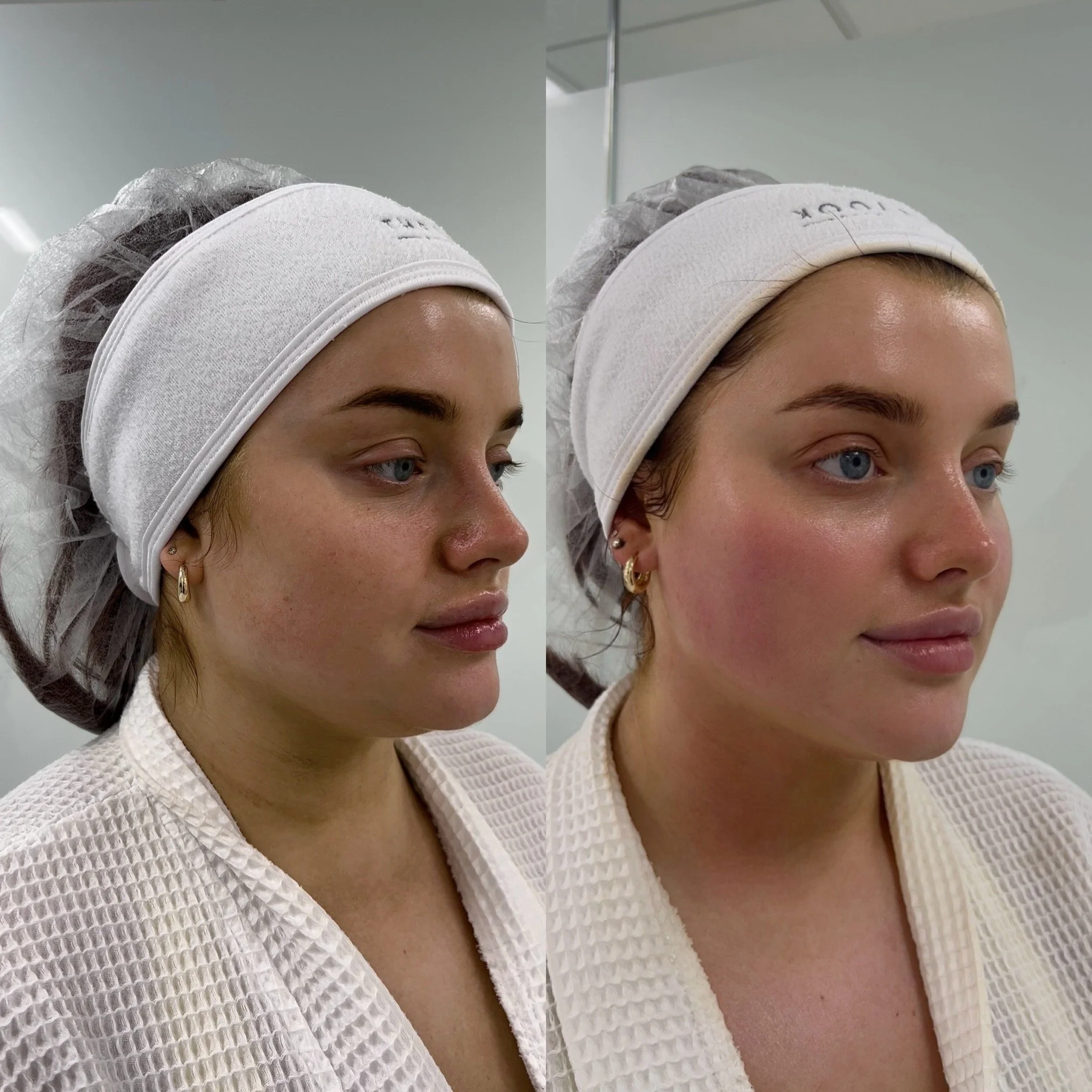 Close-up image of two women with hair covered in hairnets, wearing white textured robes, and standing side by side in a clinical or spa setting.