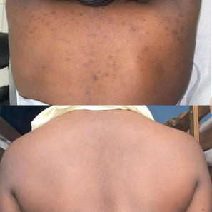 Before and after herbal peel treatment on the back demonstrating improvement in the appearance of acne, texture, dullness, and uneven-looking skin tone.