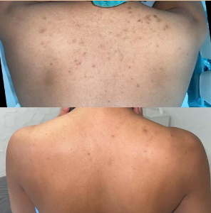 Before and after herbal peel treatment on the back demonstrating improvement in the appearance of acne, texture, dullness, and uneven-looking skin tone.