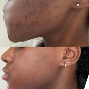 Before and after herbal peel treatment on the face demonstrating improvement in the appearance of acne, texture, dullness, and uneven-looking skin tone.
