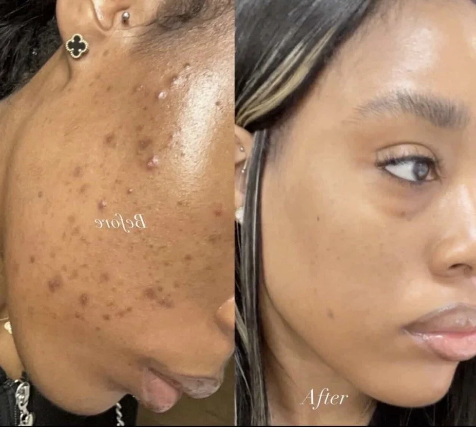Before and after herbal peel treatment on the face demonstrating improvement in the appearance of acne, texture, dullness, and uneven-looking skin tone.