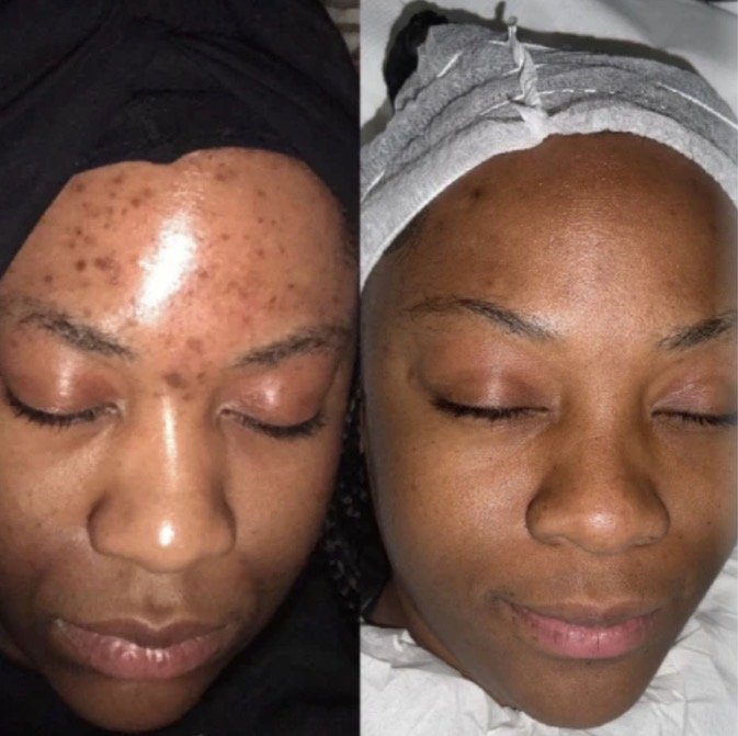 Before and after herbal peel treatment on the face demonstrating improvement in the appearance of acne, texture, dullness, and uneven-looking skin tone.