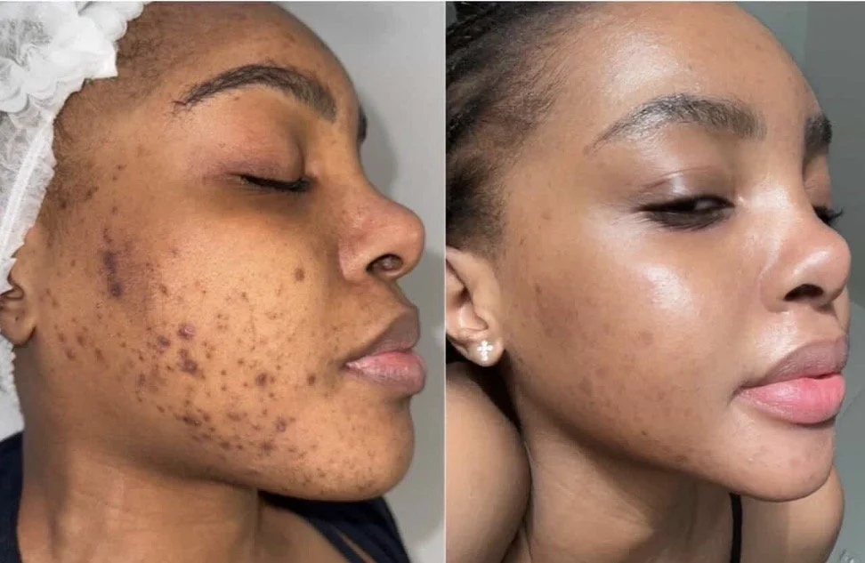 Before and after herbal peel treatment on the face demonstrating improvement in the appearance of acne, texture, dullness, and uneven-looking skin tone.