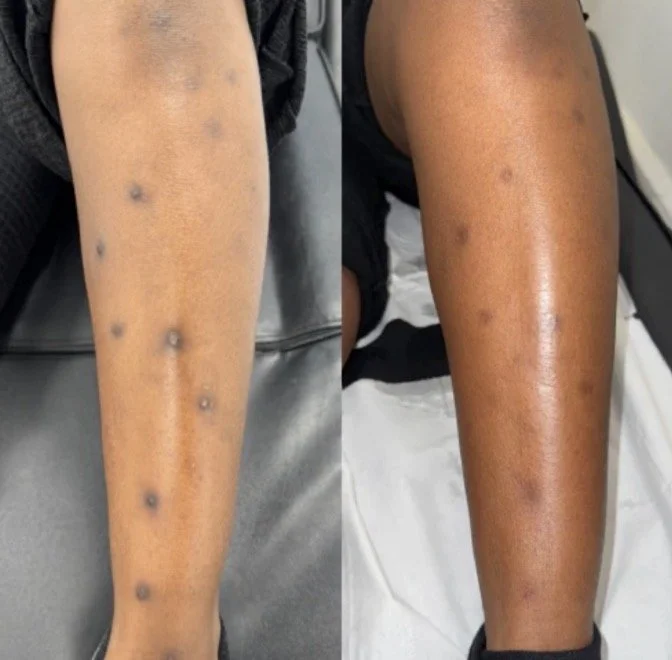 Before and after herbal peel treatment on the legs demonstrating improvement in the appearance of acne, texture, dullness, and uneven-looking skin tone.