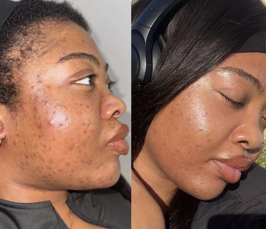 Before and after herbal peel treatment on the face demonstrating improvement in the appearance of acne, texture, dullness, and uneven-looking skin tone.
