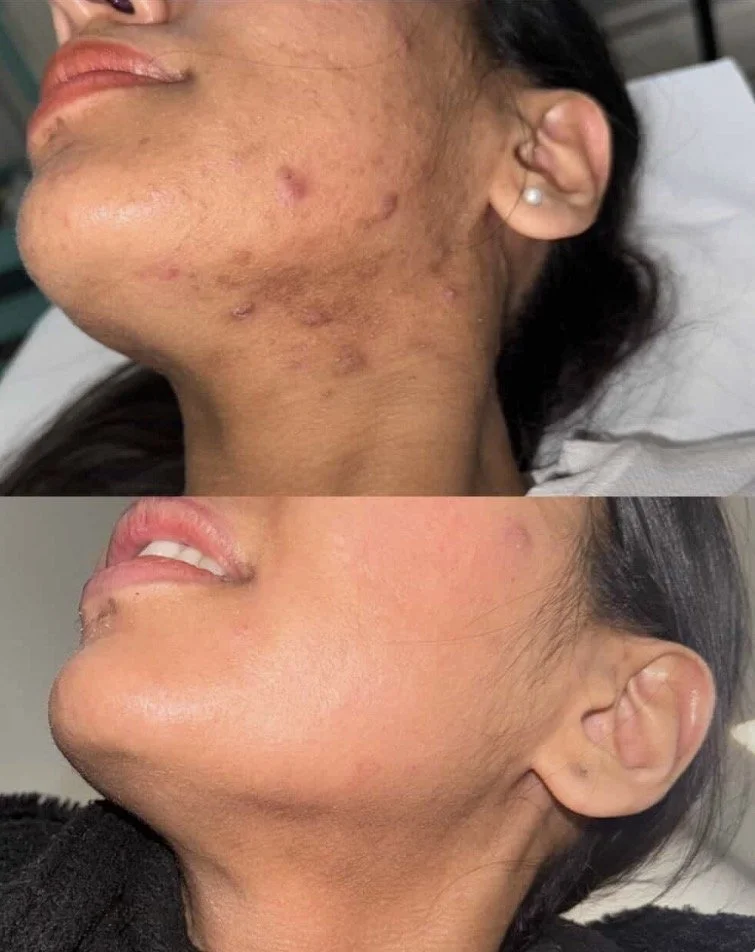 Before and after herbal peel treatment on the pcos demonstrating improvement in the appearance of acne, texture, dullness, and uneven-looking skin tone.
