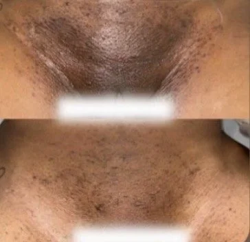 Before and after herbal peel treatment on the mons pubis demonstrating improvement in the appearance of acne, texture, dullness, and uneven-looking skin tone.