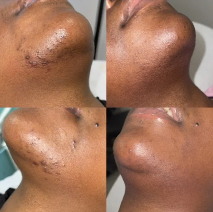 Before and after herbal peel treatment on the chin pcos demonstrating improvement in the appearance of acne, texture, dullness, and uneven-looking skin tone.
