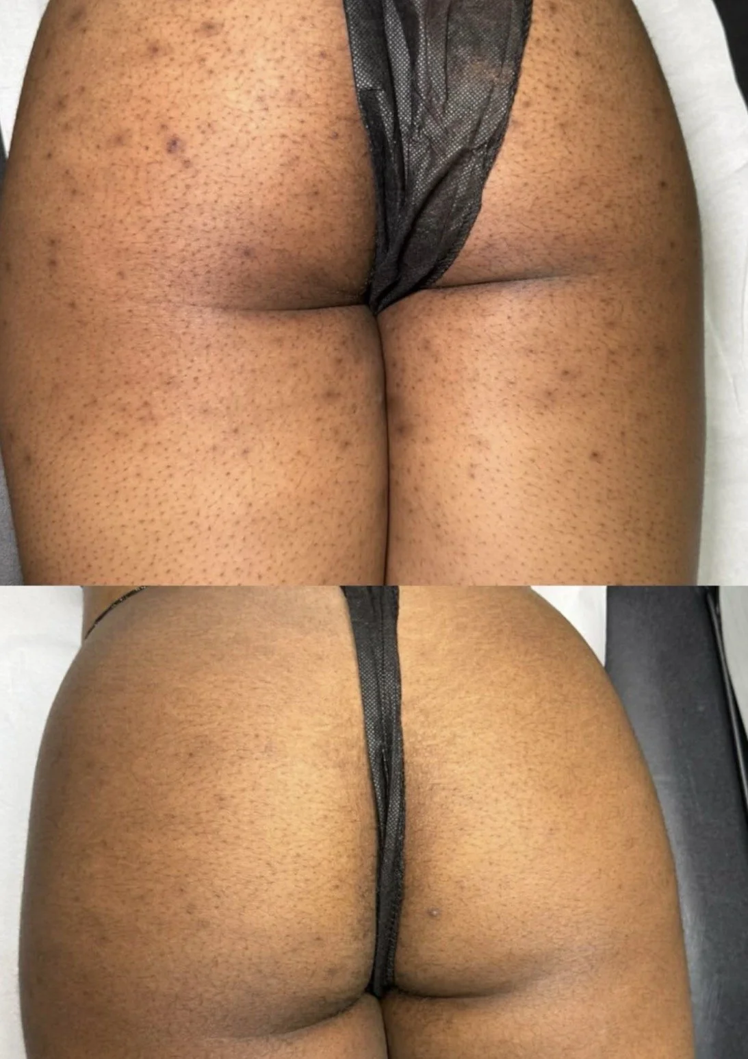 Before and after herbal peel treatment on the buttock demonstrating improvement in the appearance of acne, texture, dullness, and uneven-looking skin tone.