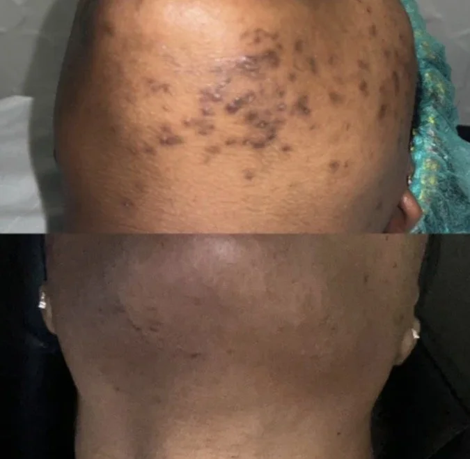 Before and after herbal peel treatment on the chindemonstrating improvement in the appearance of acne, texture, dullness, and uneven-looking skin tone.