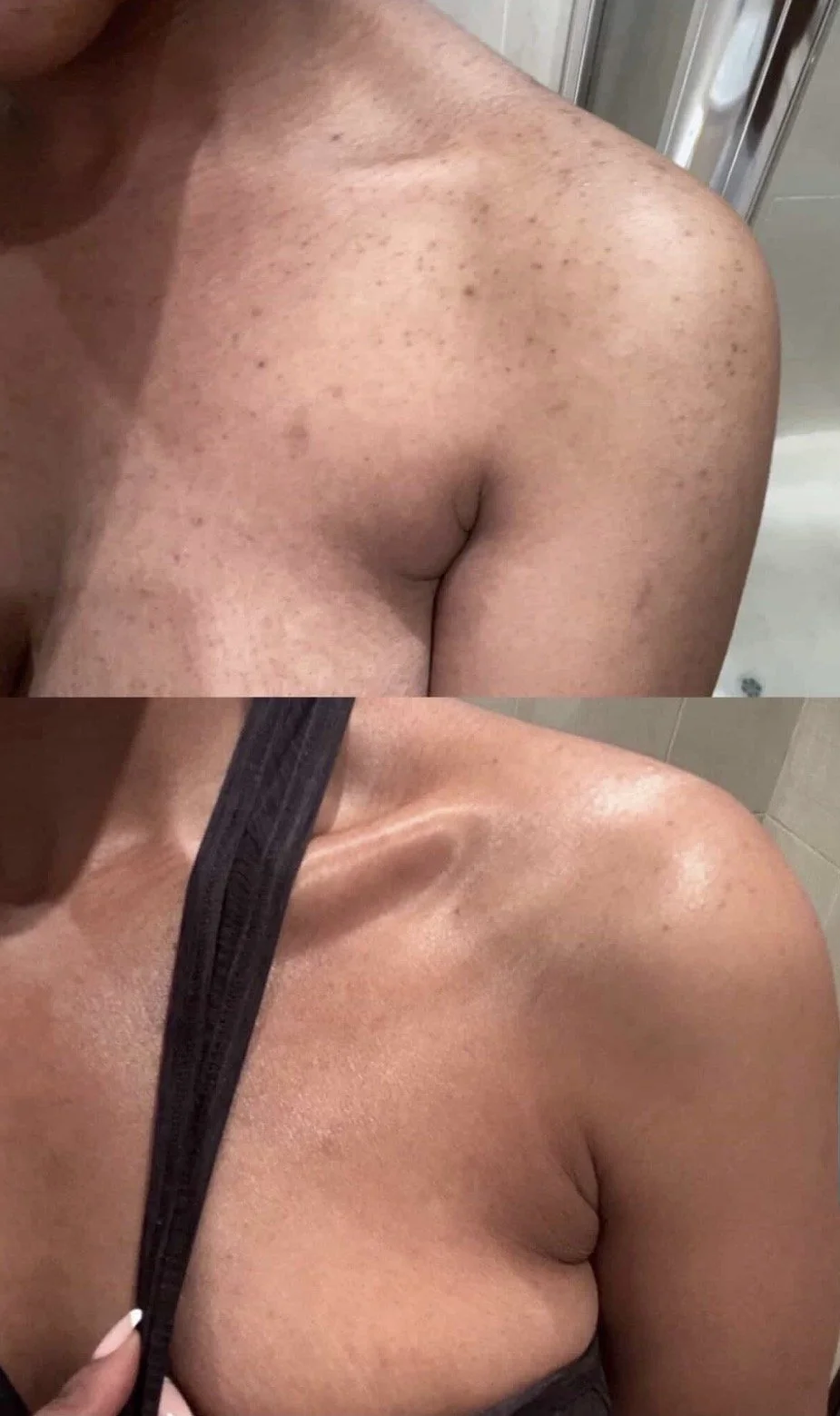 Before and after herbal peel treatment on the shoulder demonstrating improvement in the appearance of acne, texture, dullness, and uneven-looking skin tone.