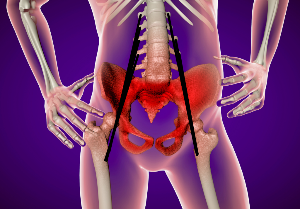 showing how the lines of the psoas muscle are similar to the lines of a suspension bridge