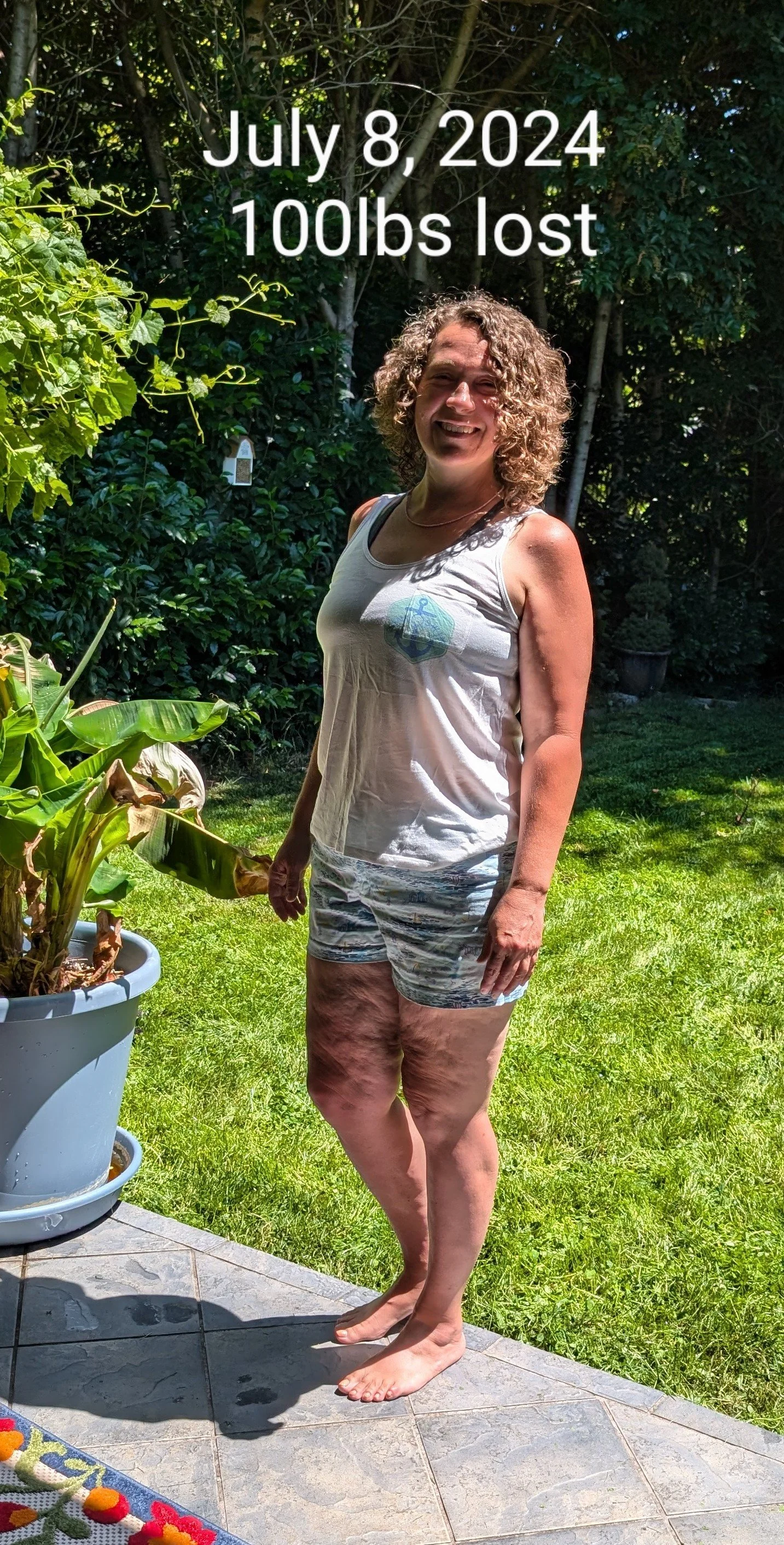 lipedema patient after conservative treatment with Dr. Rodriguez