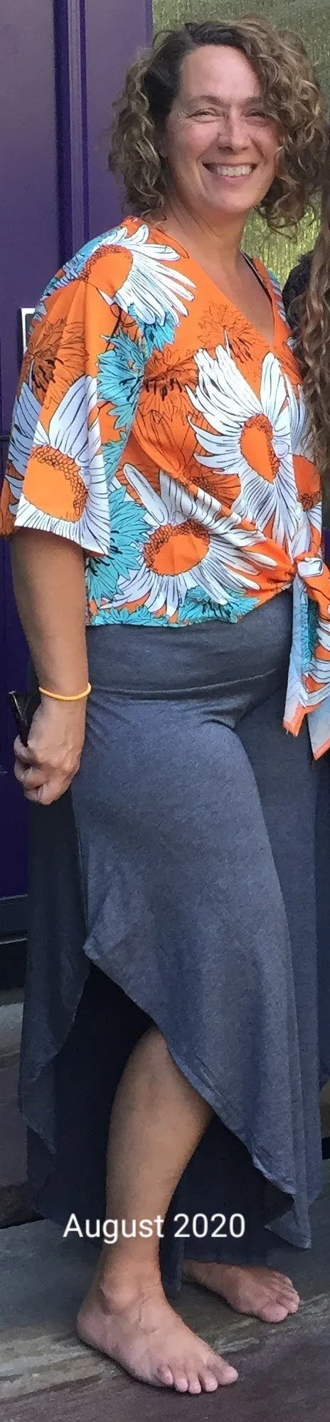 lipedema patient during conservative treatment with Dr. Rodriguez